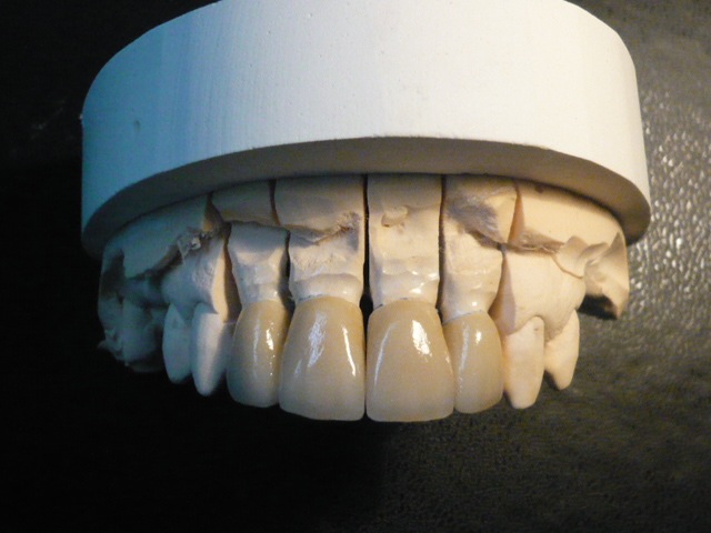 Laboratoire dentaire à Bordeaux, le Bouscat, implants, prothèses adjointe/conjointe/mixte/sur implant, traitements fichiers 3d STL...