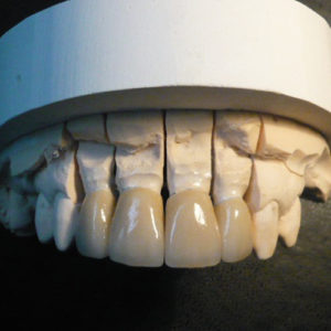 Laboratoire dentaire à Bordeaux, le Bouscat, implants, prothèses adjointe/conjointe/mixte/sur implant, traitements fichiers 3d STL...